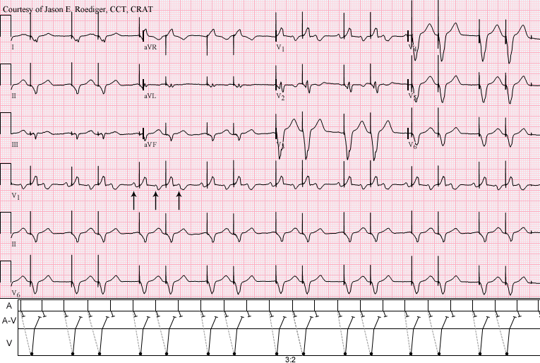 Biventricular Pacemaker Rhythm Strip biventricular-pacemaker-rhythm-strip